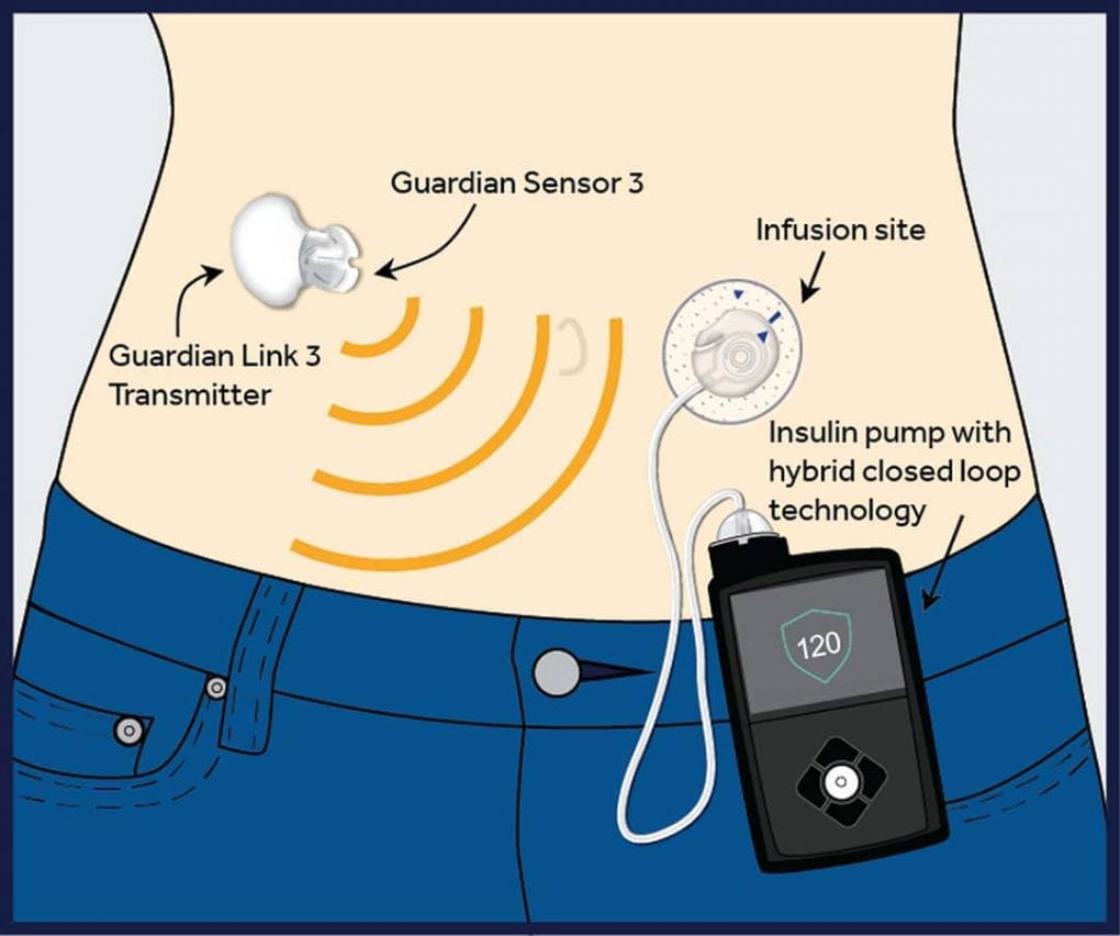 Diagram of human waistline demonstrating how an artificial insulin pump works with sensors